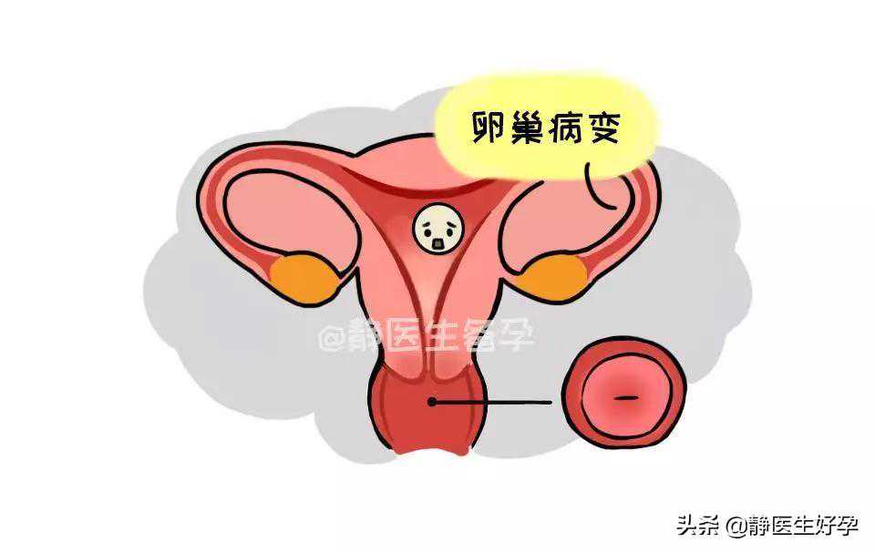 香港骏汇的廖宇新验血准确吗,备孕遇上排卵障碍，3个小妙招有效促排卵